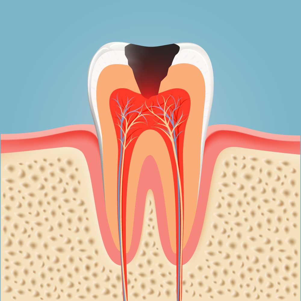 Carie Nei Bambini Con Denti Da Latte: Cosa Fare E Non Fare - Studio Lorè